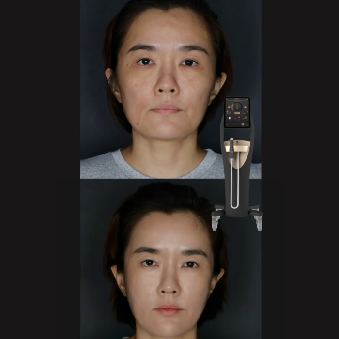 Density Noir Face Lift in Johor Bahru | Lyvin Clinic JB 